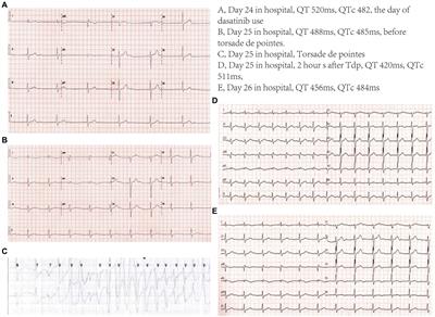 A case report of sudden cardiac arrest and torsade de pointes induced by the second-generation tyrosine kinase inhibitor dasatinib combined with fluconazole